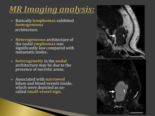  Basically lymphomas exhibited
homogeneous
architecture.
 Heterogeneous architecture of
the nodal ymphomas was
significantly low compared with
metastatic nodes.
 heterogeneity in the nodal
architecture may be due to the
presence of necrotic areas.
 Associated with narrowed
hilum and blood vessels inside,
which were depicted as so-
called small-vessel sign.
 