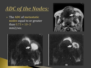  The ADC of metastatic
nodes equal to or greater
than 0.73 × 10–3
mm2/sec.
 