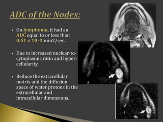  On lymphoma, it had an
ADC equal to or less than
0.51 × 10–3 mm2/sec.
 Due to increased nuclear-to-
cytoplasmic ratio and hyper-
cellularity.
 Reduce the extracellular
matrix and the diffusion
space of water protons in the
extracellular and
intracellular dimensions.
 