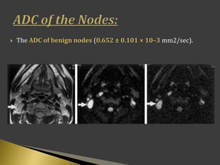  The ADC of benign nodes (0.652 ± 0.101 × 10–3 mm2/sec).
 