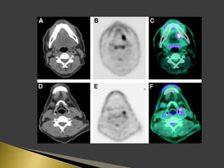 Imaging of enlarged lymph node