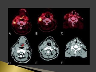 Imaging of enlarged lymph node