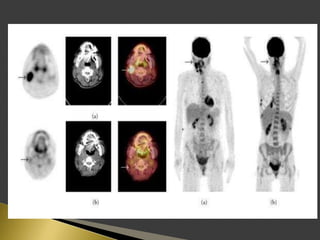 Imaging of enlarged lymph node