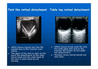 Traction Rd Fundus Imaging of eye and orbit | PDF