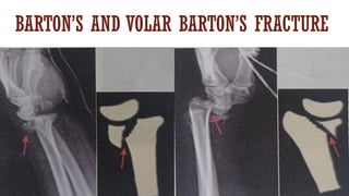 Imaging of fractures on Xray, CT and MRI.pptx