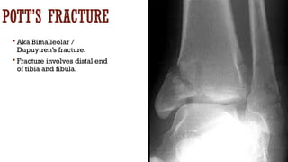 Pottys Fructure Imaging of fractures on Xray, CT and MRI.pptx