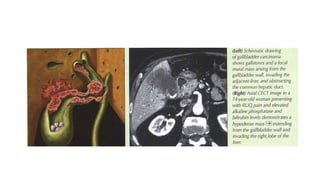 Comprehensive Imaging and Pathology of Gallbladder and Biliary Tree ...