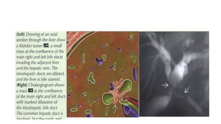 Comprehensive Imaging and Pathology of Gallbladder and Biliary Tree ...