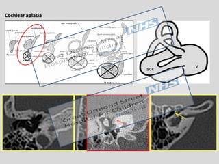 Cochlear Distortion Imaging of hearing loss: Sensorineural hearing loss | PDF