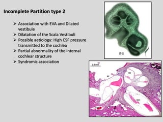 Imaging of hearing loss: Sensorineural hearing loss | PDF