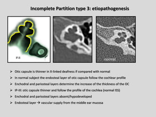 Imaging of hearing loss: Sensorineural hearing loss | PDF