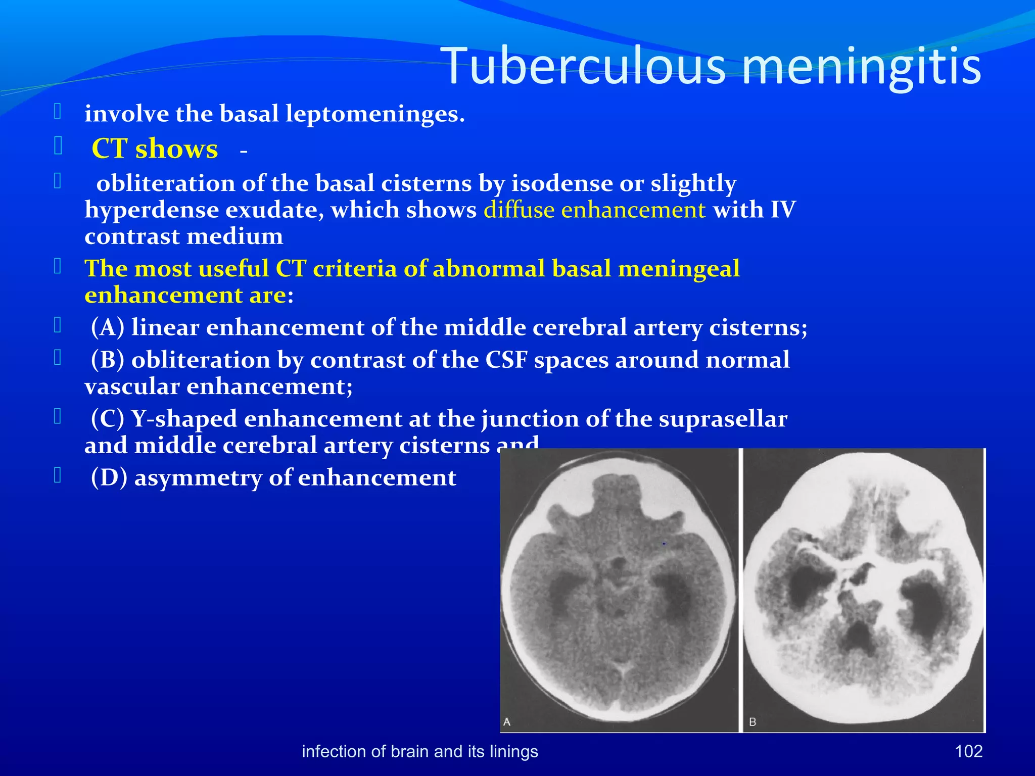 Tuberculous meningitis
 involve the basal leptomeninges.
 CT shows -
 obliteration of the basal cisterns by isodense or slightly
hyperdense exudate, which shows diffuse enhancement with IV
contrast medium
 The most useful CT criteria of abnormal basal meningeal
enhancement are:
 (A) linear enhancement of the middle cerebral artery cisterns;
 (B) obliteration by contrast of the CSF spaces around normal
vascular enhancement;
 (C) Y-shaped enhancement at the junction of the suprasellar
and middle cerebral artery cisterns and
 (D) asymmetry of enhancement
102infection of brain and its linings
 