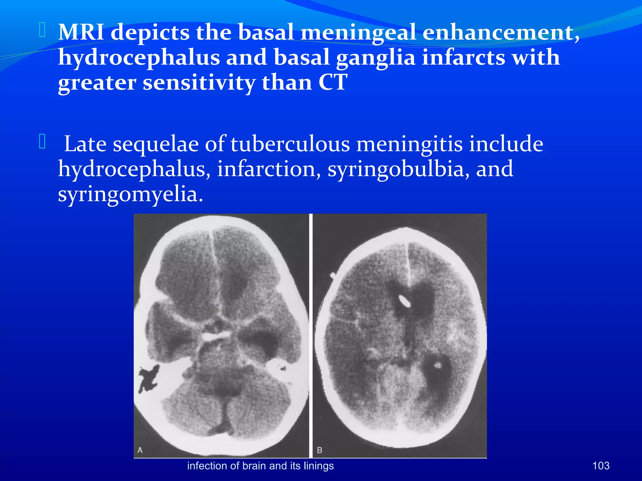 infection of brain and its linings 103
 MRI depicts the basal meningeal enhancement,
hydrocephalus and basal ganglia infarcts with
greater sensitivity than CT
 Late sequelae of tuberculous meningitis include
hydrocephalus, infarction, syringobulbia, and
syringomyelia.
 
