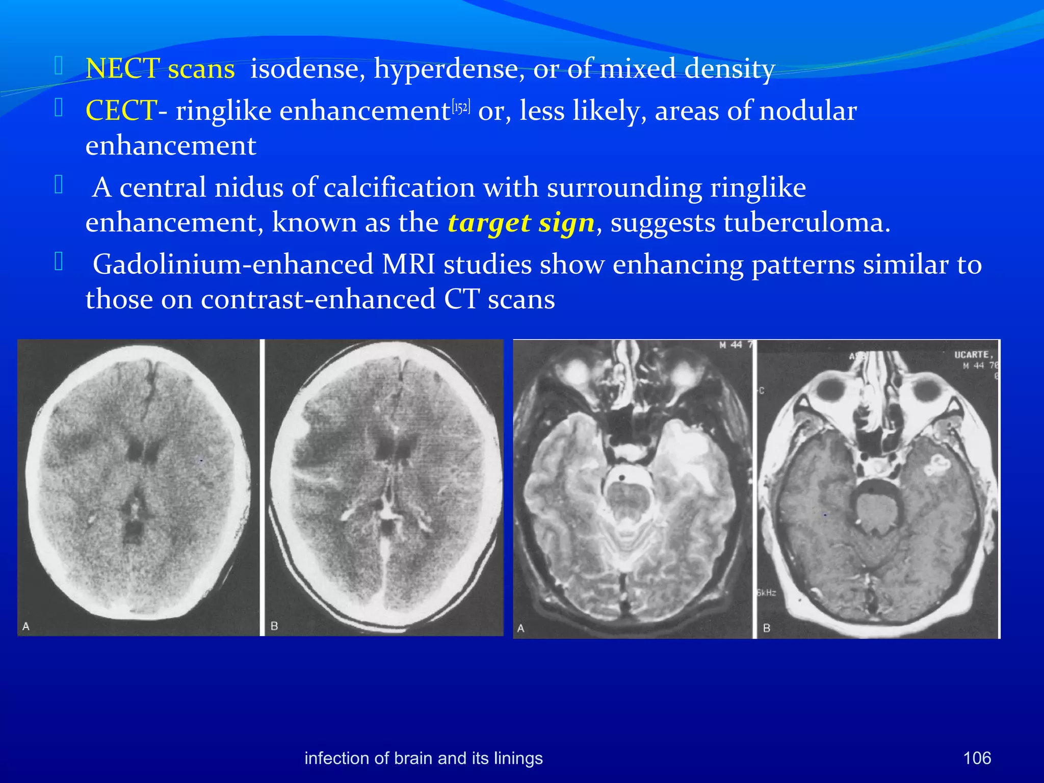 106
 NECT scans isodense, hyperdense, or of mixed density
 CECT- ringlike enhancement[152]
or, less likely, areas of nodular
enhancement
 A central nidus of calcification with surrounding ringlike
enhancement, known as the target sign, suggests tuberculoma.
 Gadolinium-enhanced MRI studies show enhancing patterns similar to
those on contrast-enhanced CT scans
infection of brain and its linings
 
