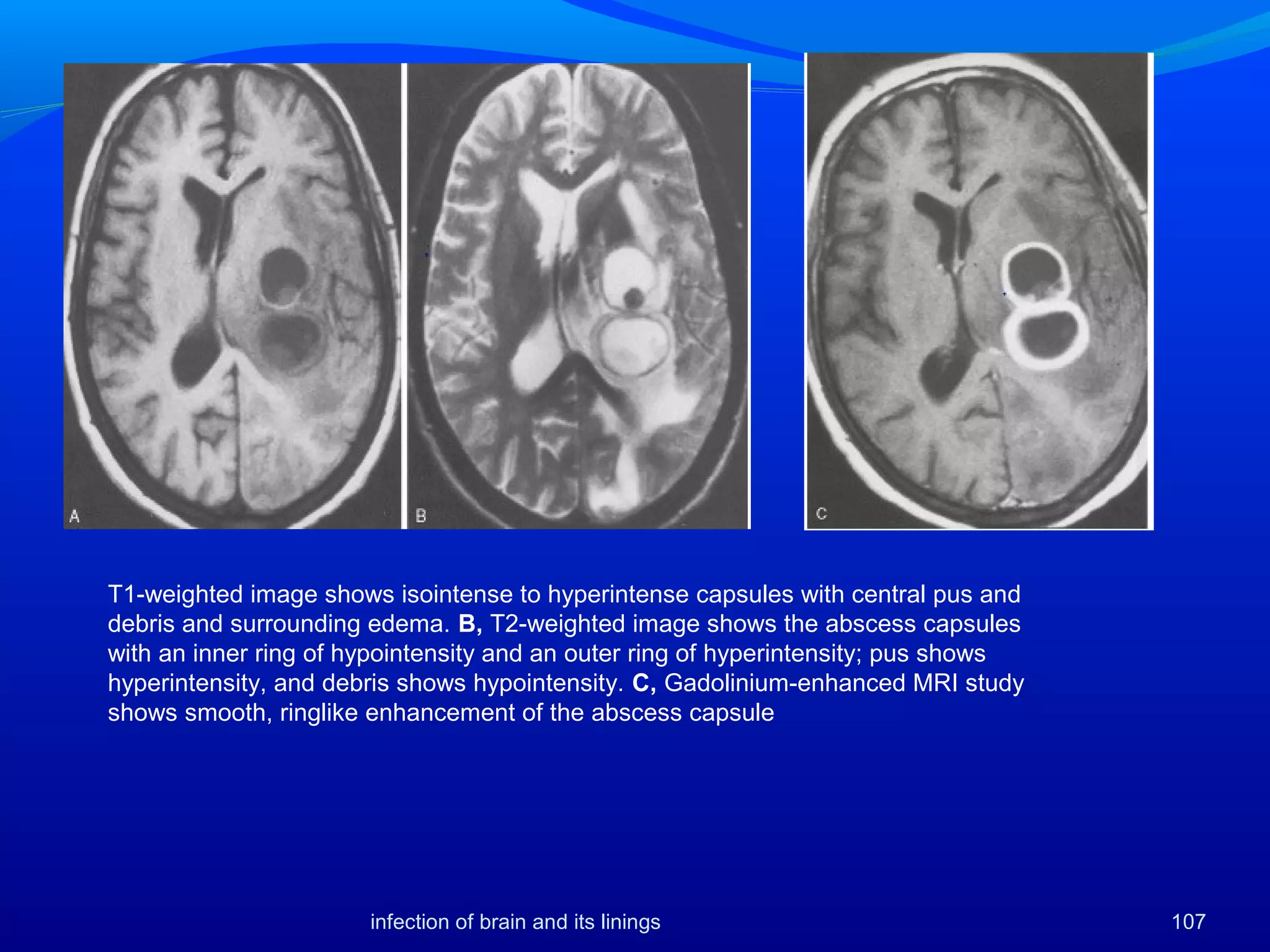 107
T1-weighted image shows isointense to hyperintense capsules with central pus and
debris and surrounding edema. B, T2-weighted image shows the abscess capsules
with an inner ring of hypointensity and an outer ring of hyperintensity; pus shows
hyperintensity, and debris shows hypointensity. C, Gadolinium-enhanced MRI study
shows smooth, ringlike enhancement of the abscess capsule
infection of brain and its linings
 