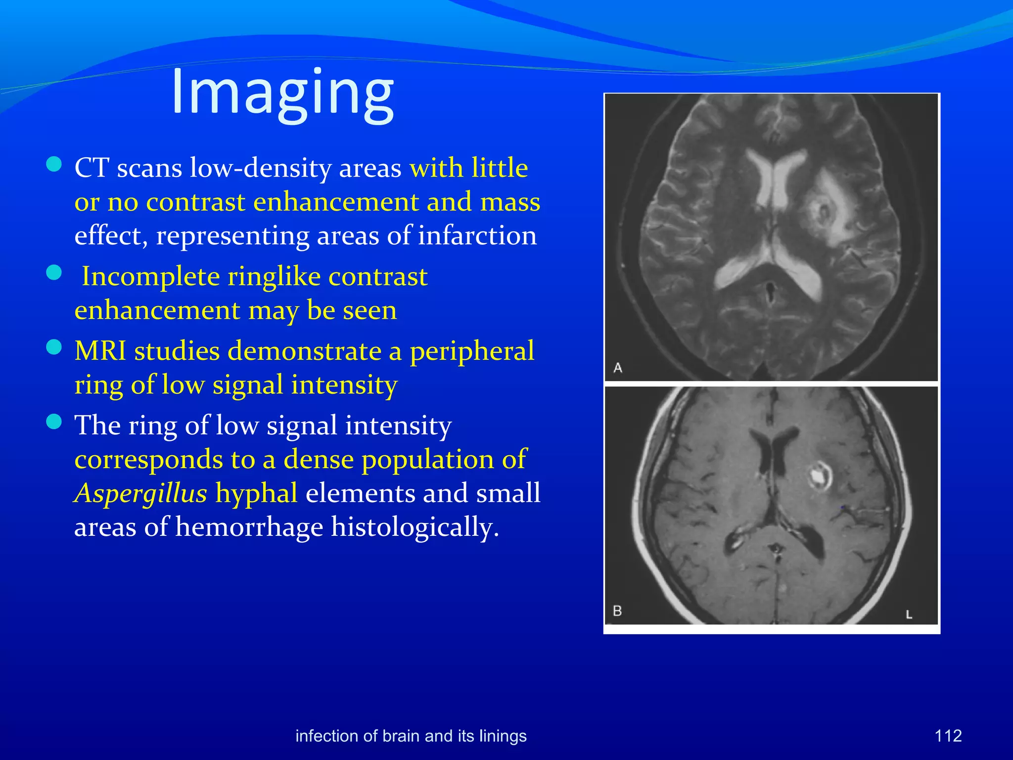 Imaging
CT scans low-density areas with little
or no contrast enhancement and mass
effect, representing areas of infarction
 Incomplete ringlike contrast
enhancement may be seen
MRI studies demonstrate a peripheral
ring of low signal intensity
The ring of low signal intensity
corresponds to a dense population of
Aspergillus hyphal elements and small
areas of hemorrhage histologically.
112infection of brain and its linings
 