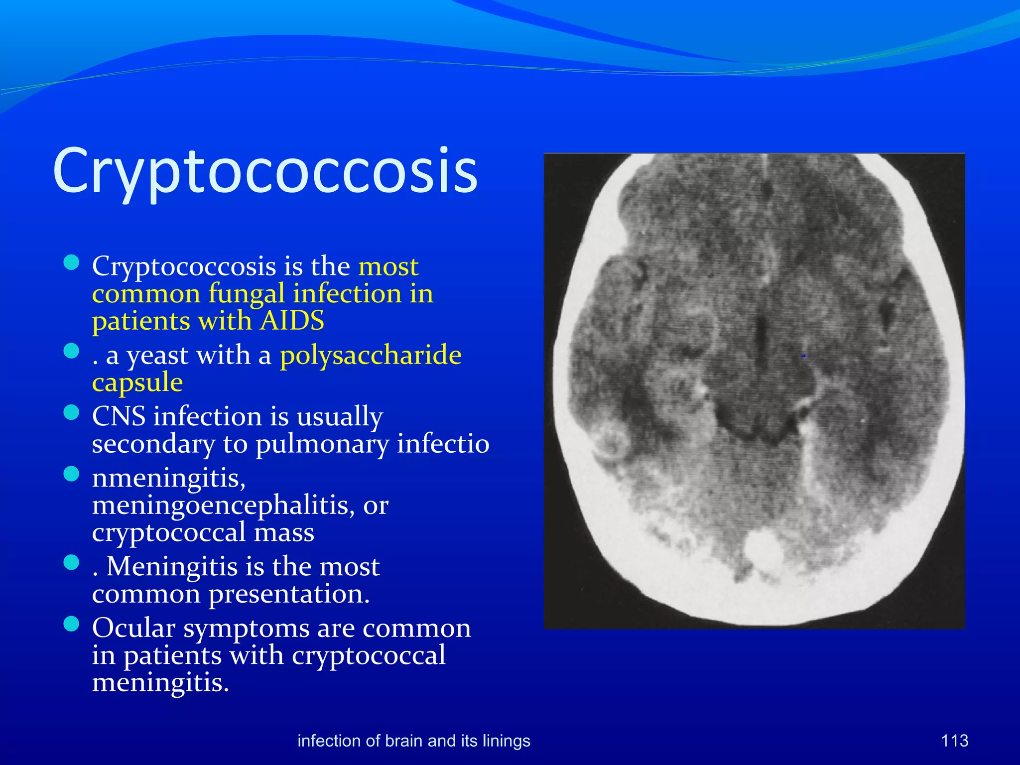 Cryptococcosis
Cryptococcosis is the most
common fungal infection in
patients with AIDS
. a yeast with a polysaccharide
capsule
CNS infection is usually
secondary to pulmonary infectio
nmeningitis,
meningoencephalitis, or
cryptococcal mass
. Meningitis is the most
common presentation.
Ocular symptoms are common
in patients with cryptococcal
meningitis.
infection of brain and its linings 113
 