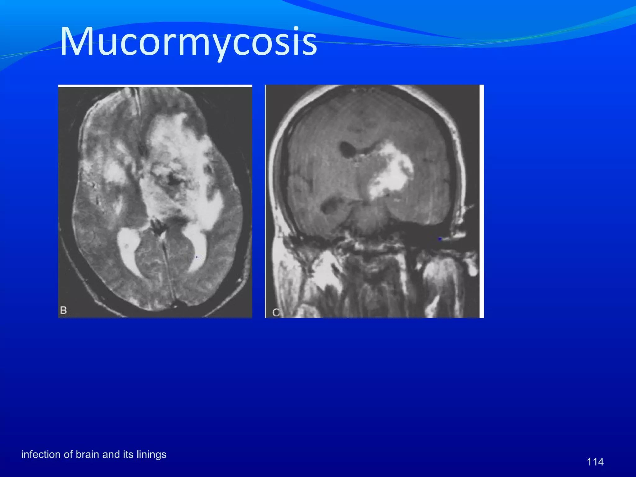 Mucormycosis
infection of brain and its linings
114
 