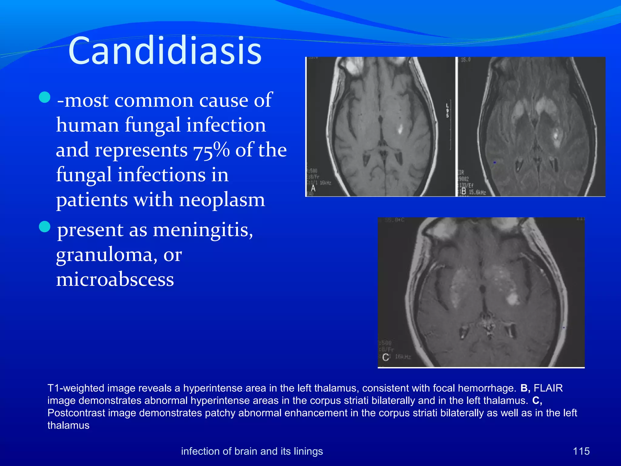 Candidiasis
-most common cause of
human fungal infection
and represents 75% of the
fungal infections in
patients with neoplasm
present as meningitis,
granuloma, or
microabscess
infection of brain and its linings 115
T1-weighted image reveals a hyperintense area in the left thalamus, consistent with focal hemorrhage. B, FLAIR
image demonstrates abnormal hyperintense areas in the corpus striati bilaterally and in the left thalamus. C,
Postcontrast image demonstrates patchy abnormal enhancement in the corpus striati bilaterally as well as in the left
thalamus
 