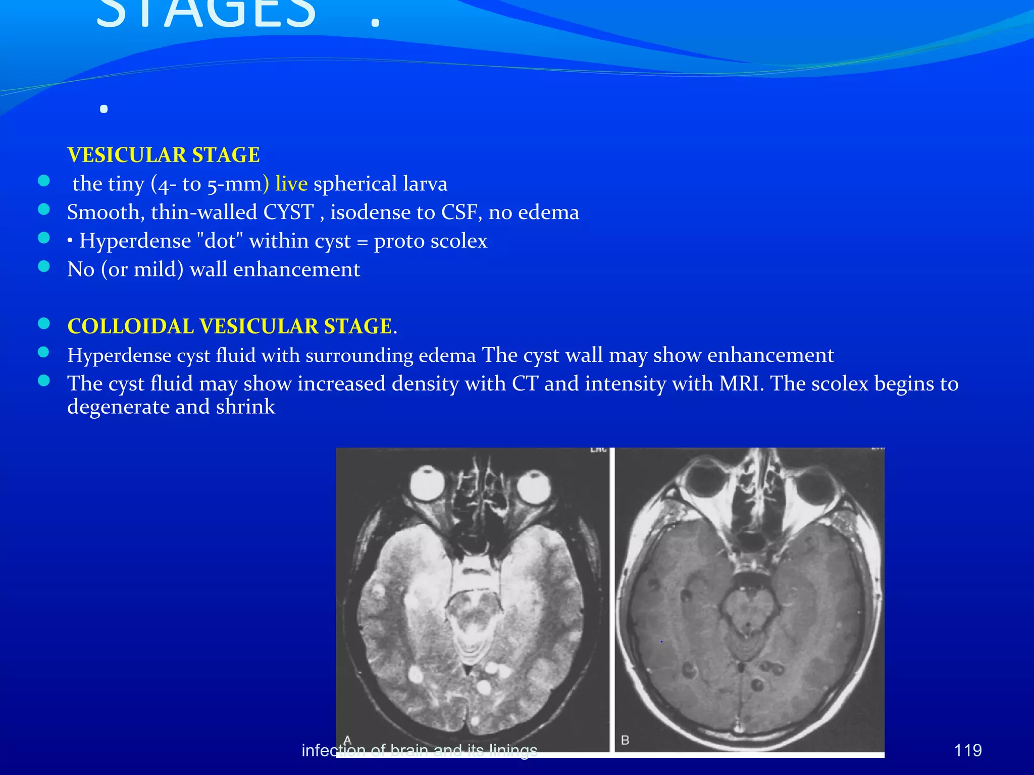 119
STAGES .
.
VESICULAR STAGE
 the tiny (4- to 5-mm) live spherical larva
 Smooth, thin-walled CYST , isodense to CSF, no edema
 • Hyperdense "dot" within cyst = proto scolex
 No (or mild) wall enhancement
 COLLOIDAL VESICULAR STAGE.
 Hyperdense cyst fluid with surrounding edema The cyst wall may show enhancement
 The cyst fluid may show increased density with CT and intensity with MRI. The scolex begins to
degenerate and shrink
infection of brain and its linings
 