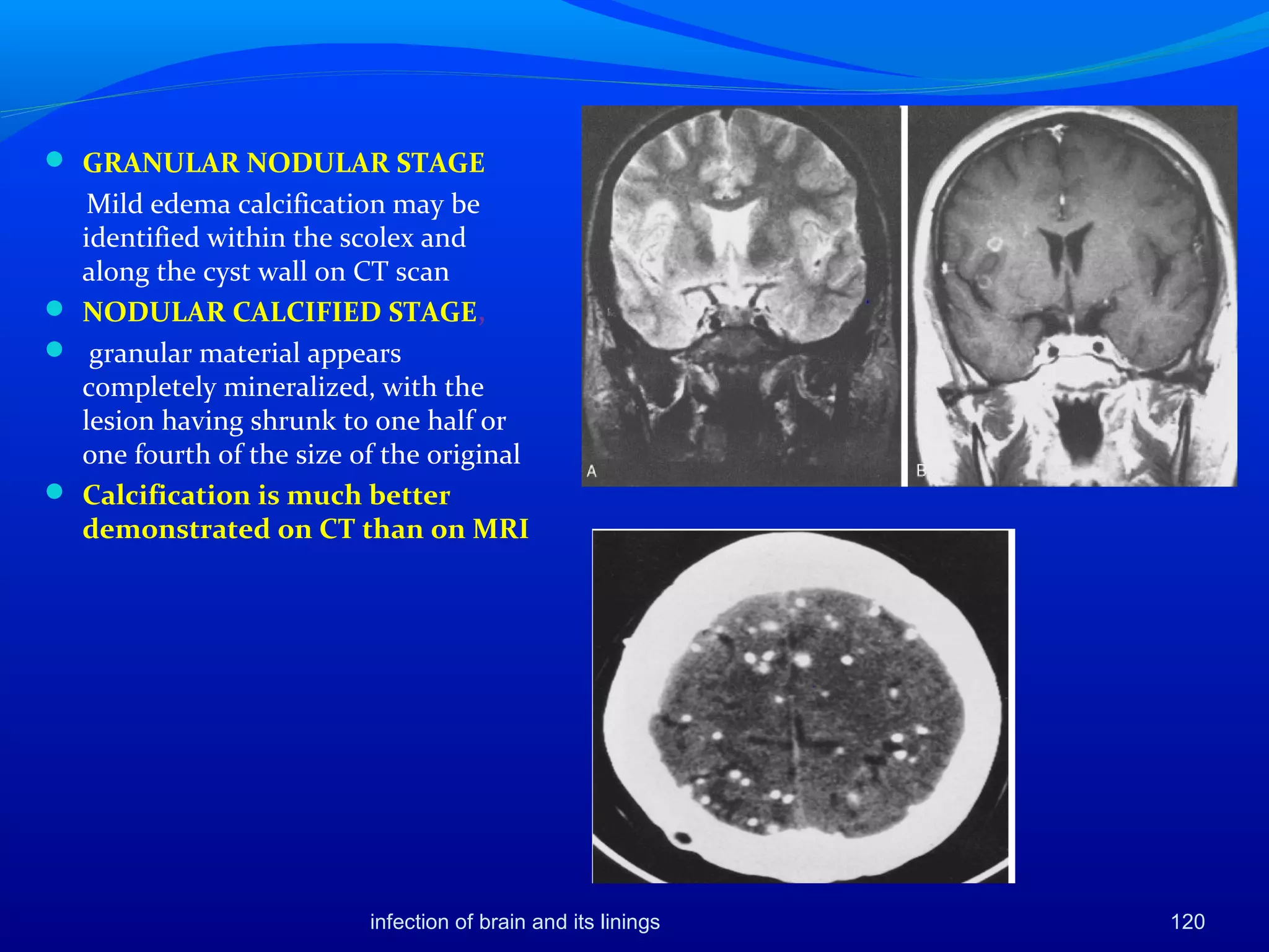  GRANULAR NODULAR STAGE
Mild edema calcification may be
identified within the scolex and
along the cyst wall on CT scan
 NODULAR CALCIFIED STAGE,
 granular material appears
completely mineralized, with the
lesion having shrunk to one half or
one fourth of the size of the original
 Calcification is much better
demonstrated on CT than on MRI
120infection of brain and its linings
 
