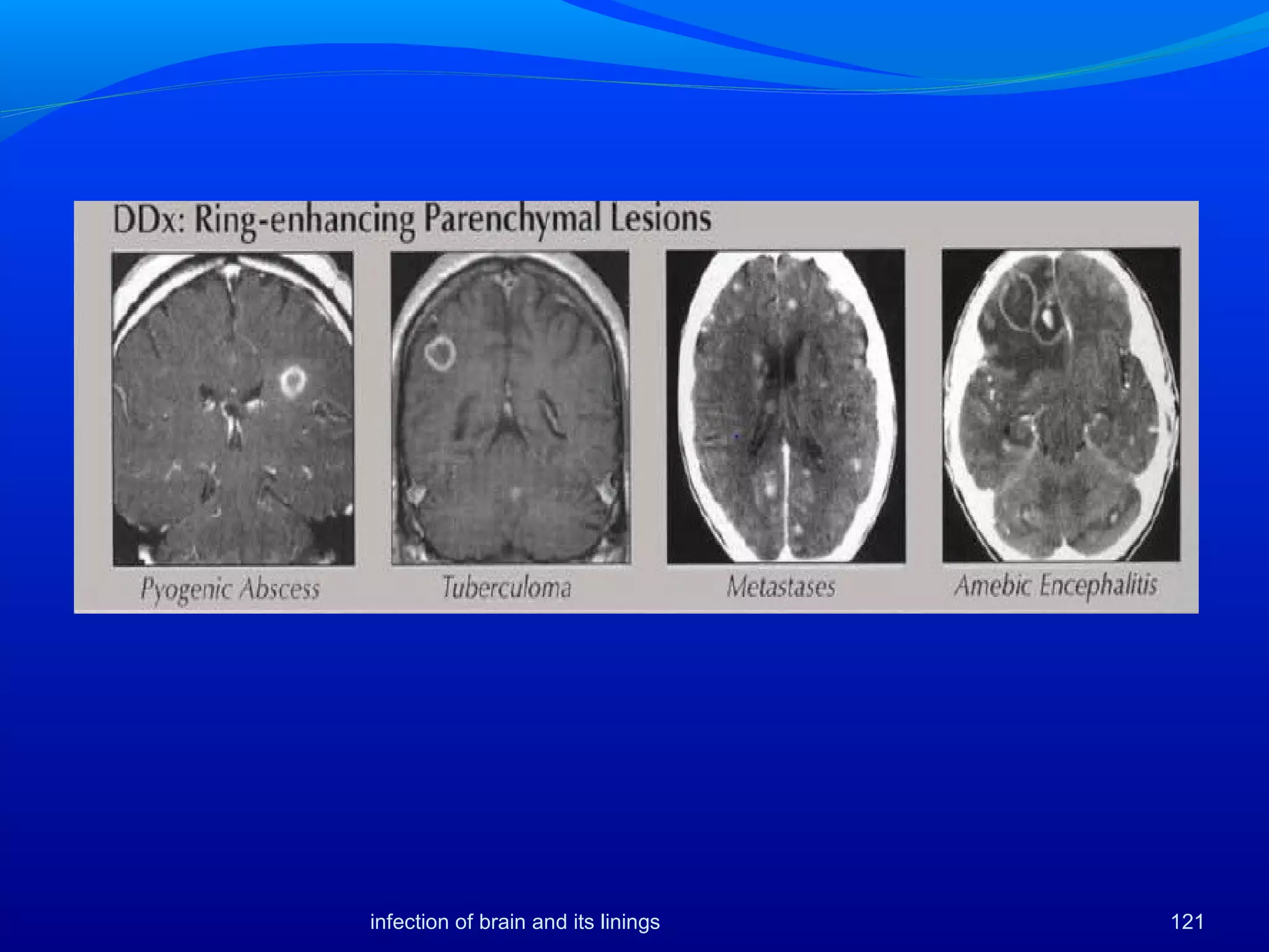 121infection of brain and its linings
 