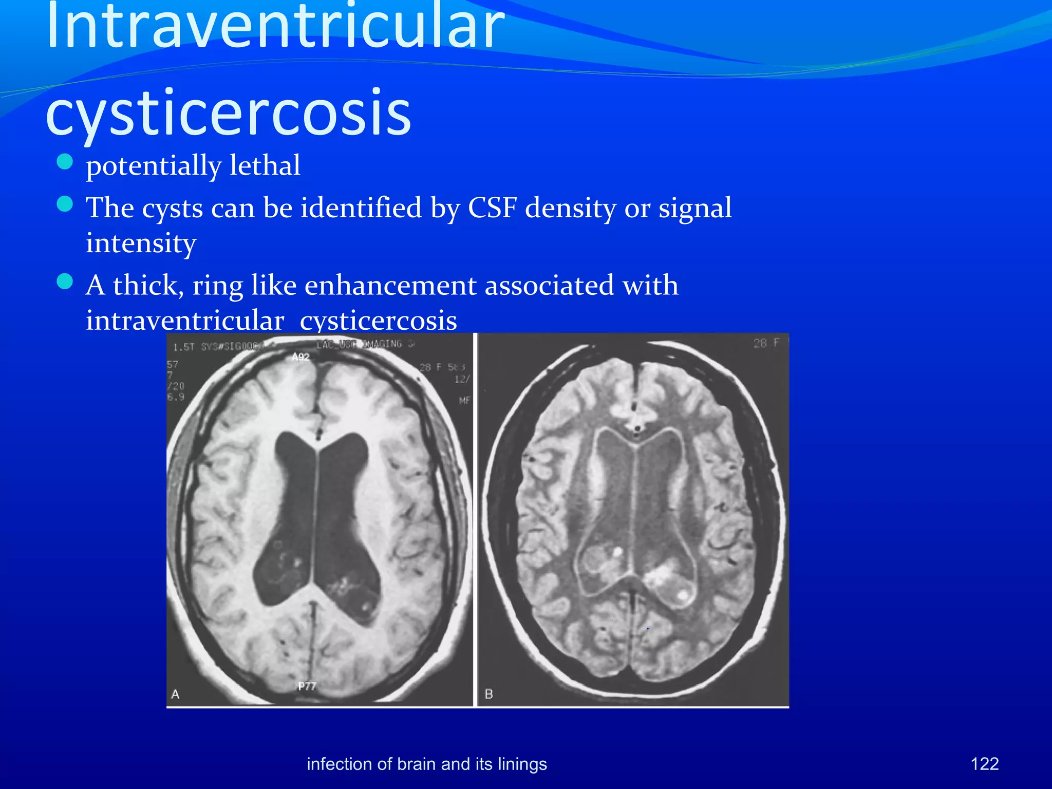 Intraventricular
cysticercosis
potentially lethal
The cysts can be identified by CSF density or signal
intensity
A thick, ring like enhancement associated with
intraventricular cysticercosis
122infection of brain and its linings
 