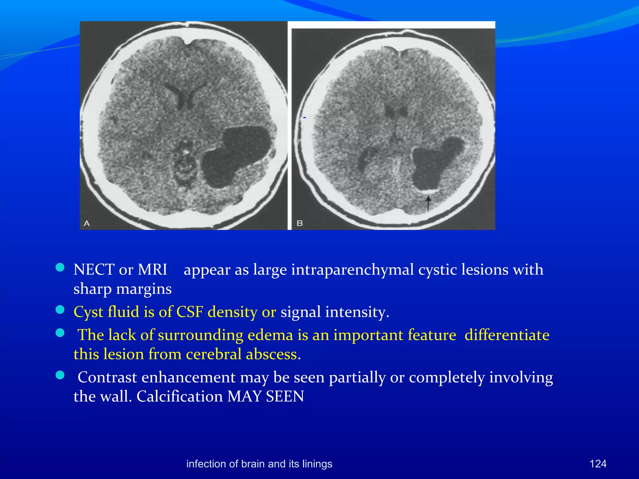 infection of brain and its linings 124
 NECT or MRI appear as large intraparenchymal cystic lesions with
sharp margins
 Cyst fluid is of CSF density or signal intensity.
 The lack of surrounding edema is an important feature differentiate
this lesion from cerebral abscess.
 Contrast enhancement may be seen partially or completely involving
the wall. Calcification MAY SEEN
 