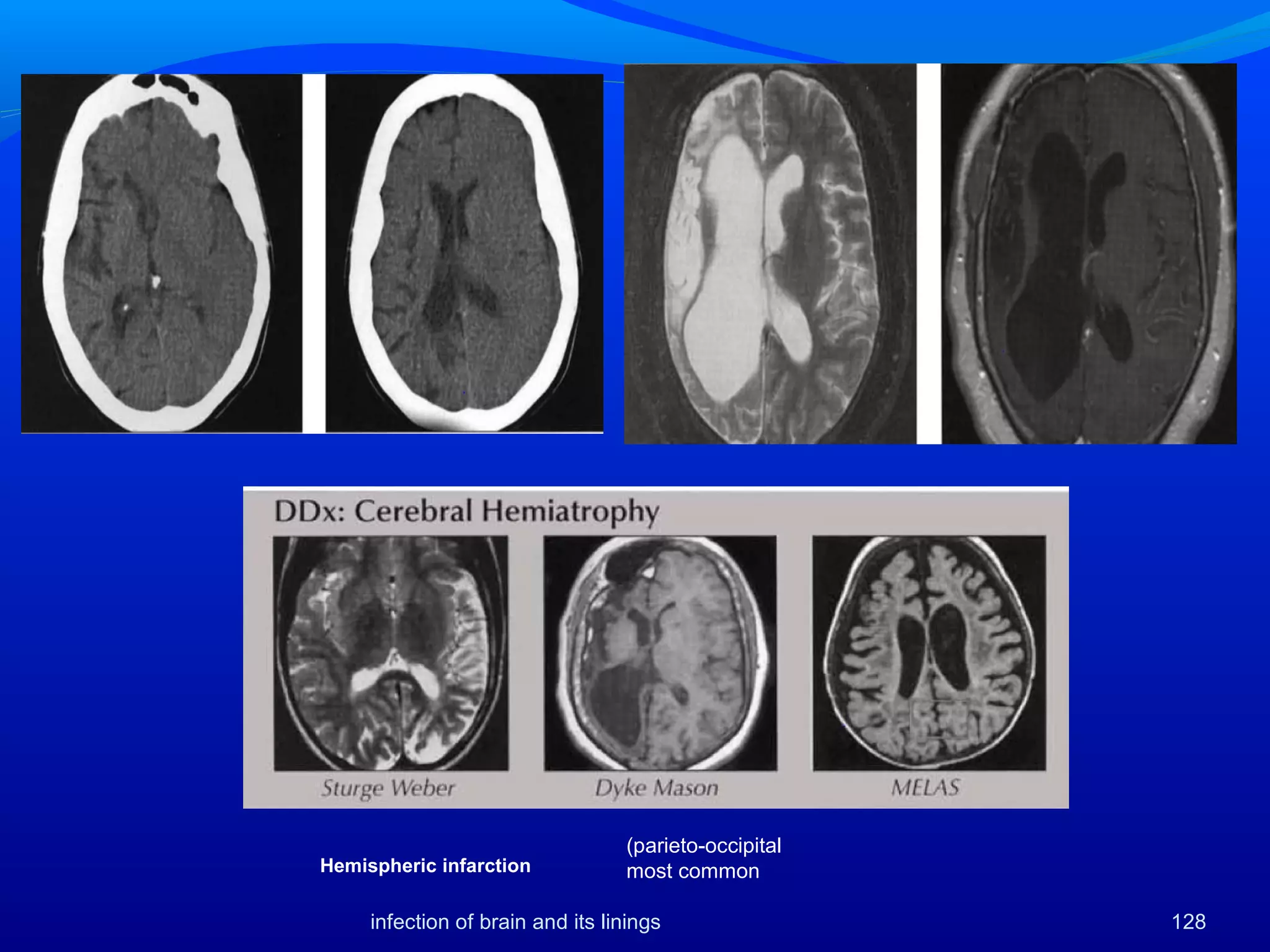 (parieto-occipital
most commonHemispheric infarction
128infection of brain and its linings
 