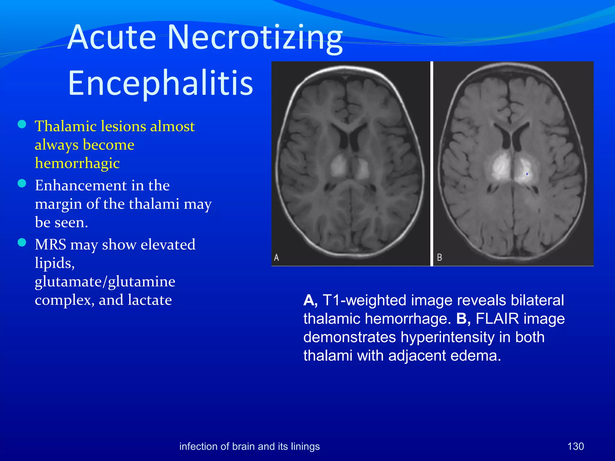 Acute Necrotizing
Encephalitis
 Thalamic lesions almost
always become
hemorrhagic
 Enhancement in the
margin of the thalami may
be seen.
 MRS may show elevated
lipids,
glutamate/glutamine
complex, and lactate A, T1-weighted image reveals bilateral
thalamic hemorrhage. B, FLAIR image
demonstrates hyperintensity in both
thalami with adjacent edema.
130infection of brain and its linings
 