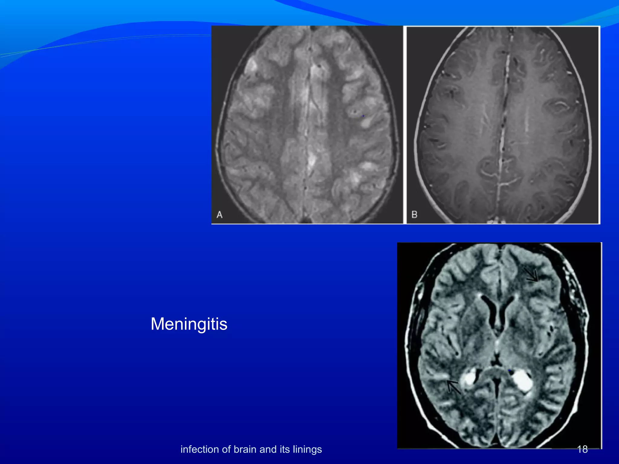 Meningitis
18infection of brain and its linings
 