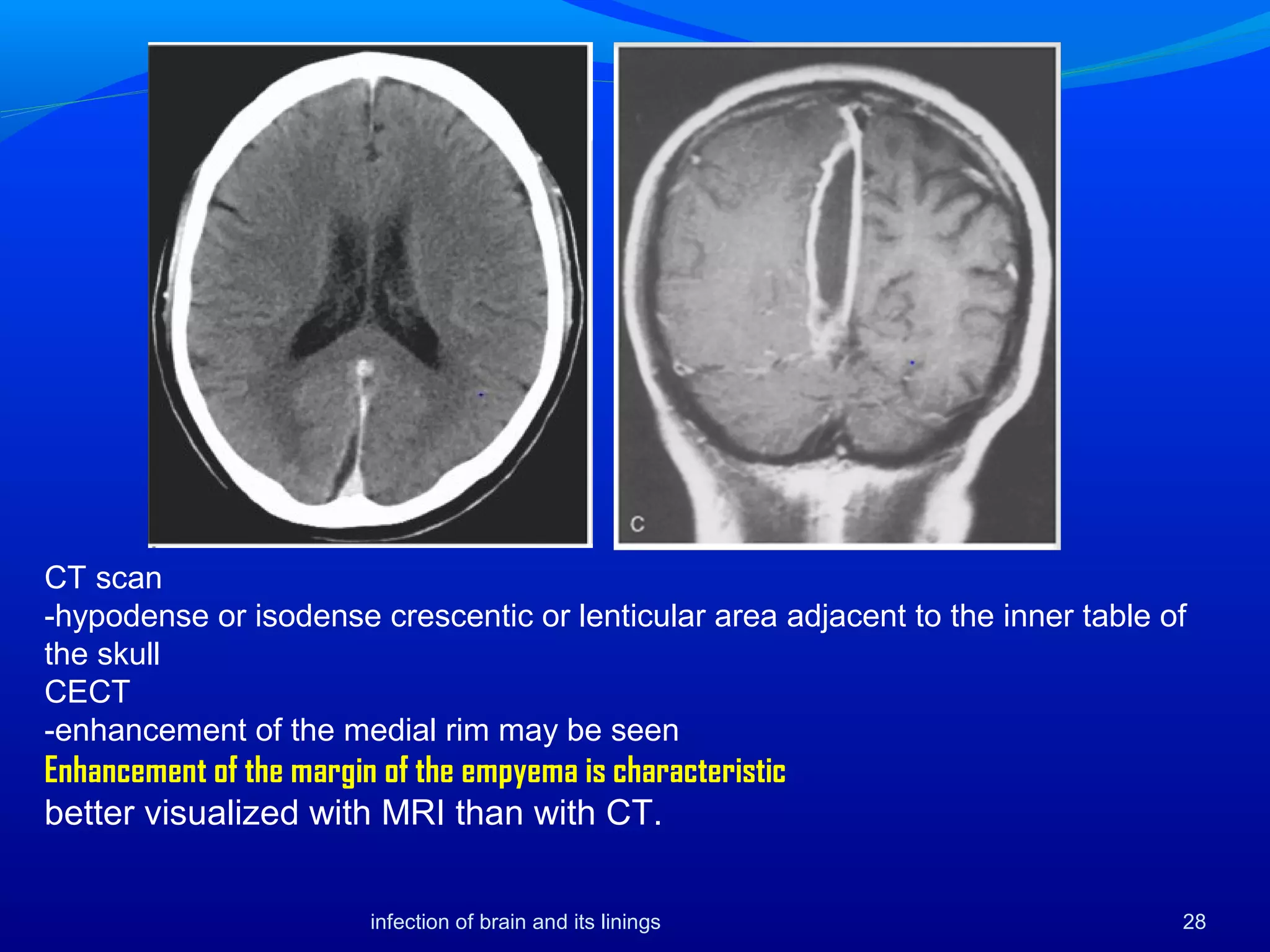 CT scan
-hypodense or isodense crescentic or lenticular area adjacent to the inner table of
the skull
CECT
-enhancement of the medial rim may be seen
Enhancement of the margin of the empyema is characteristic
better visualized with MRI than with CT.
28infection of brain and its linings
 
