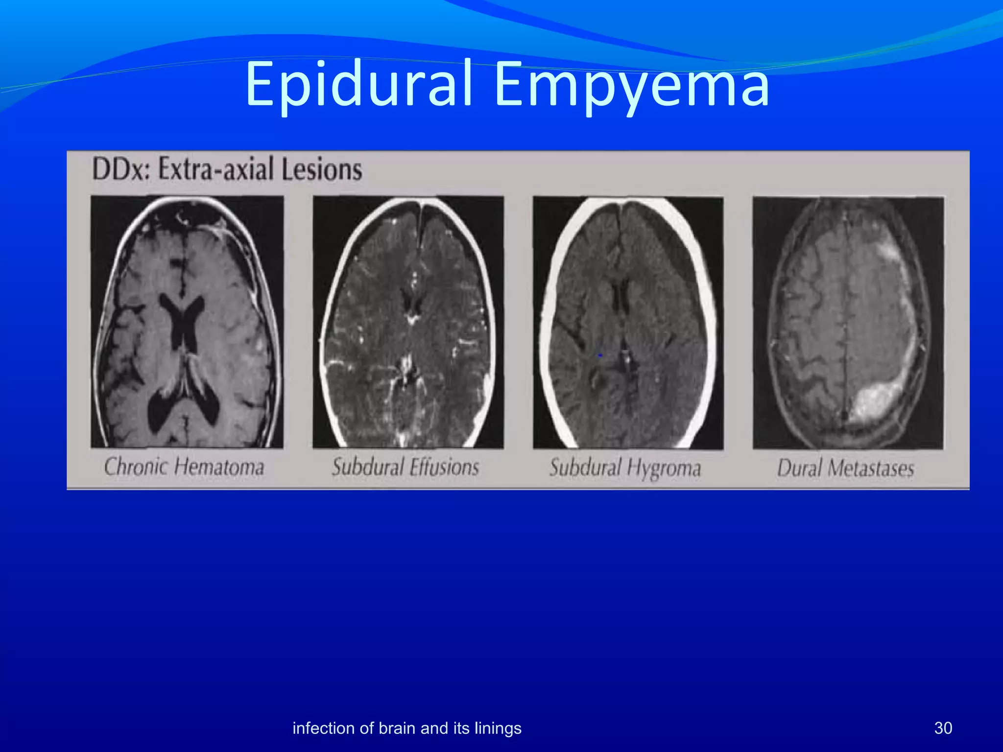 Epidural Empyema
30infection of brain and its linings
 