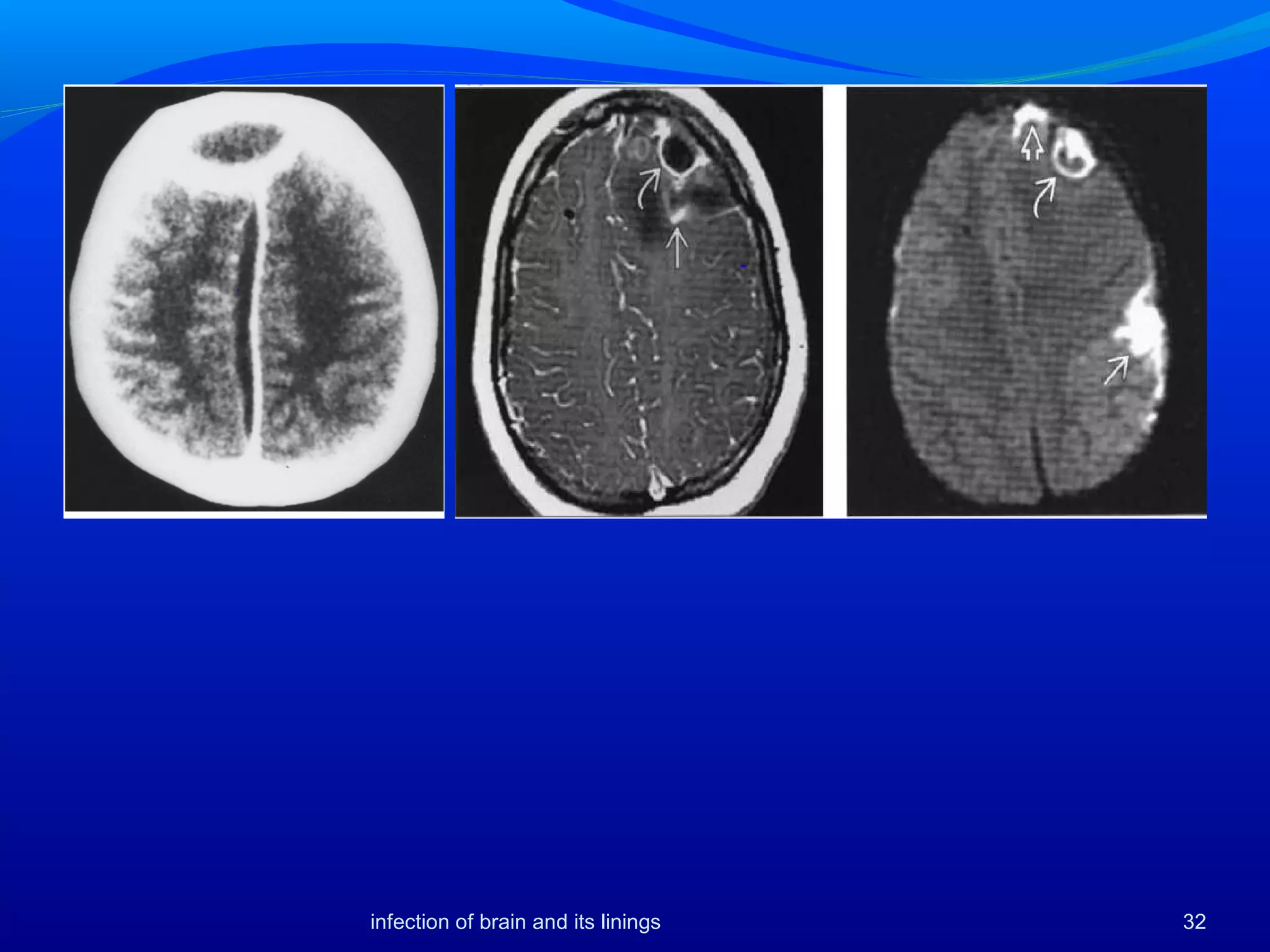 32infection of brain and its linings
 