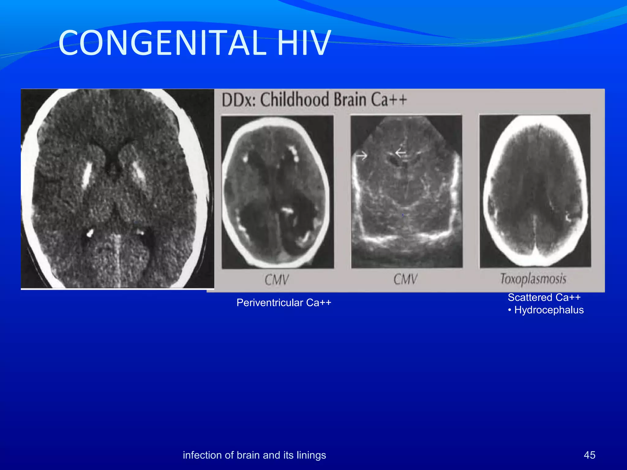CONGENITAL HIV
Scattered Ca++
• Hydrocephalus
Periventricular Ca++
45infection of brain and its linings
 