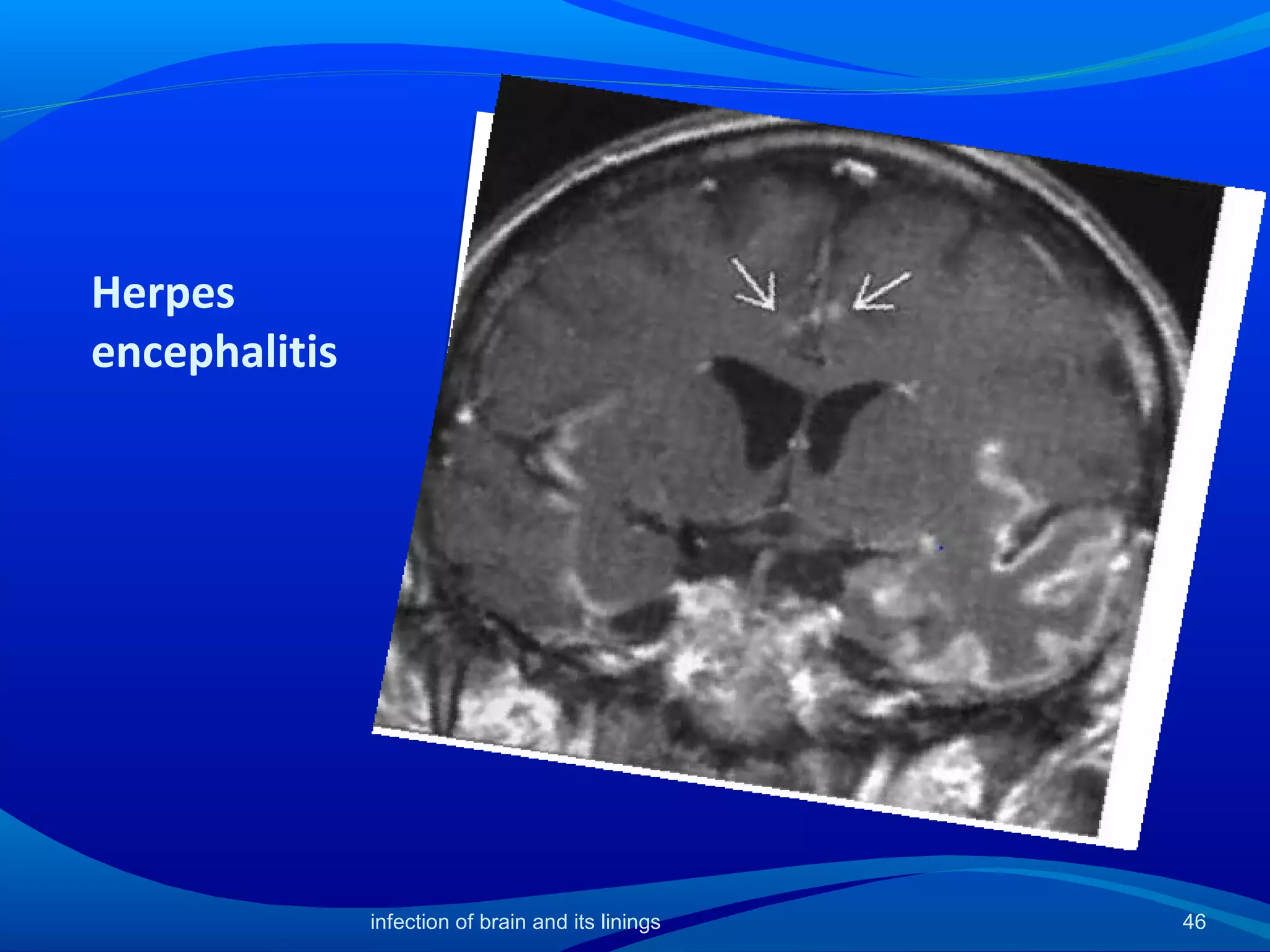 Herpes
encephalitis
46infection of brain and its linings
 