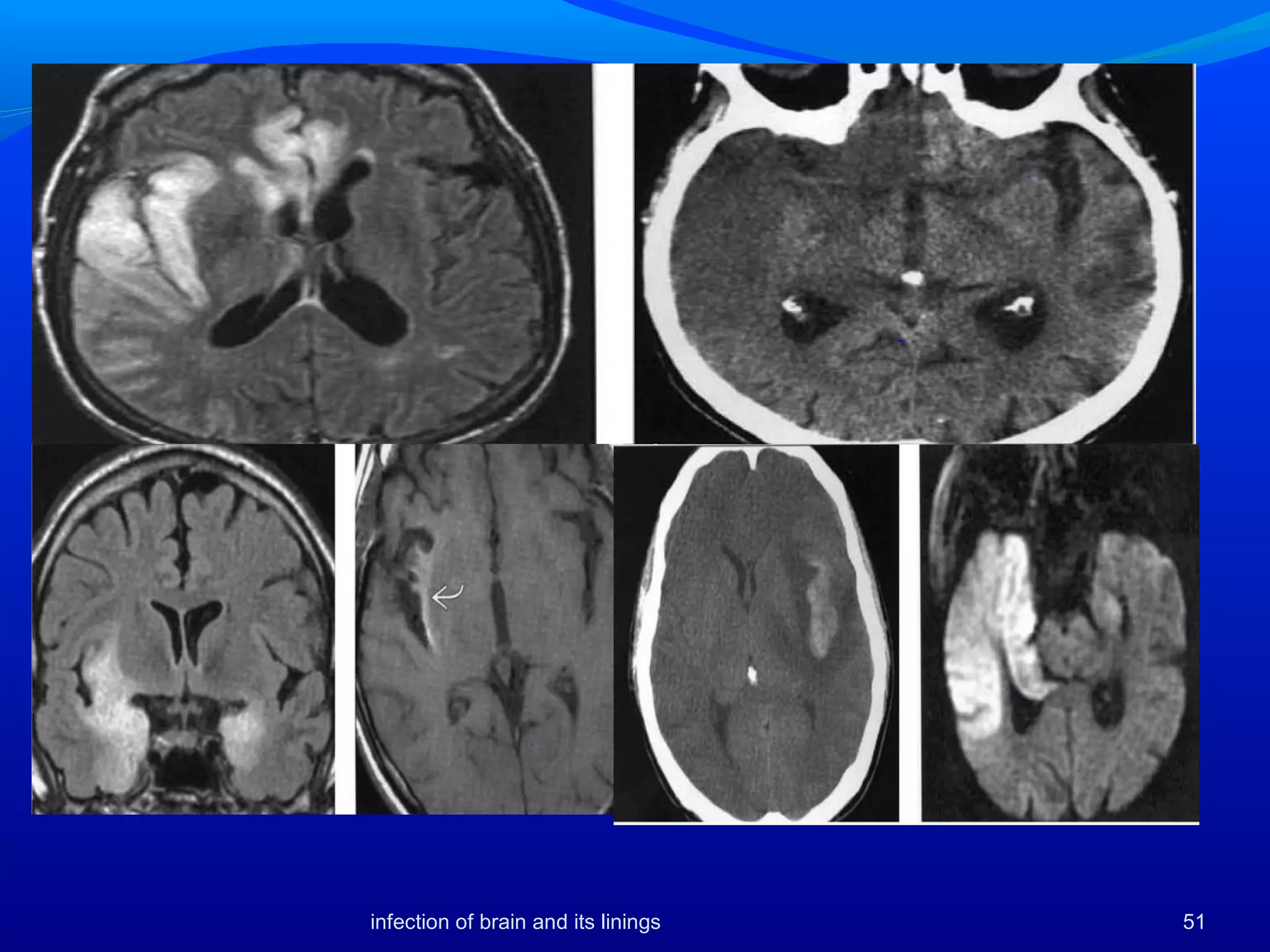 51infection of brain and its linings
 