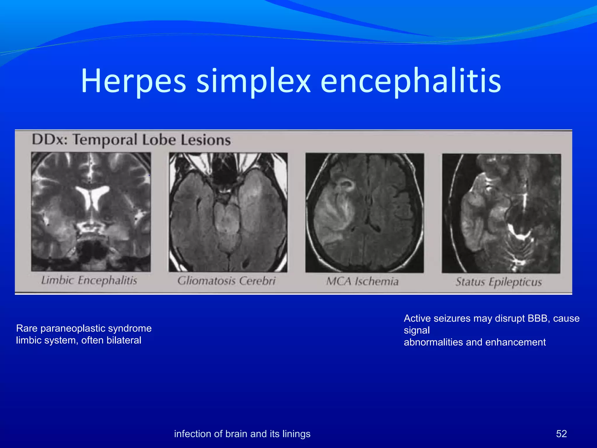 Herpes simplex encephalitis
Rare paraneoplastic syndrome
limbic system, often bilateral
Active seizures may disrupt BBB, cause
signal
abnormalities and enhancement
52infection of brain and its linings
 