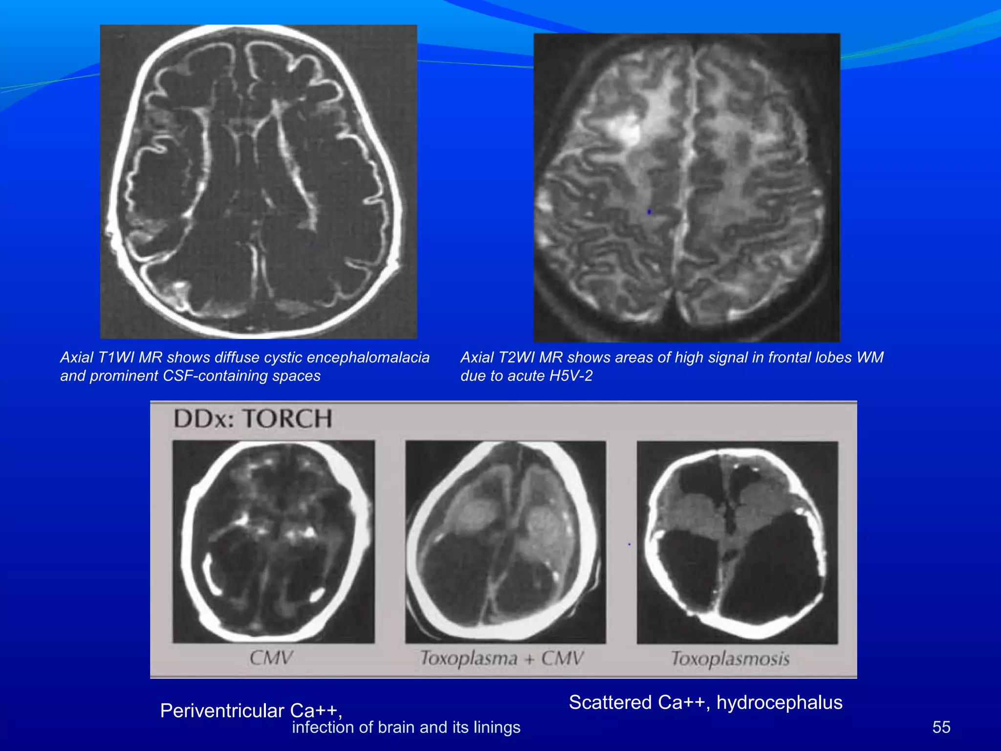 Axial T2WI MR shows areas of high signal in frontal lobes WM
due to acute H5V-2
Axial T1WI MR shows diffuse cystic encephalomalacia
and prominent CSF-containing spaces
Scattered Ca++, hydrocephalusPeriventricular Ca++,
55infection of brain and its linings
 