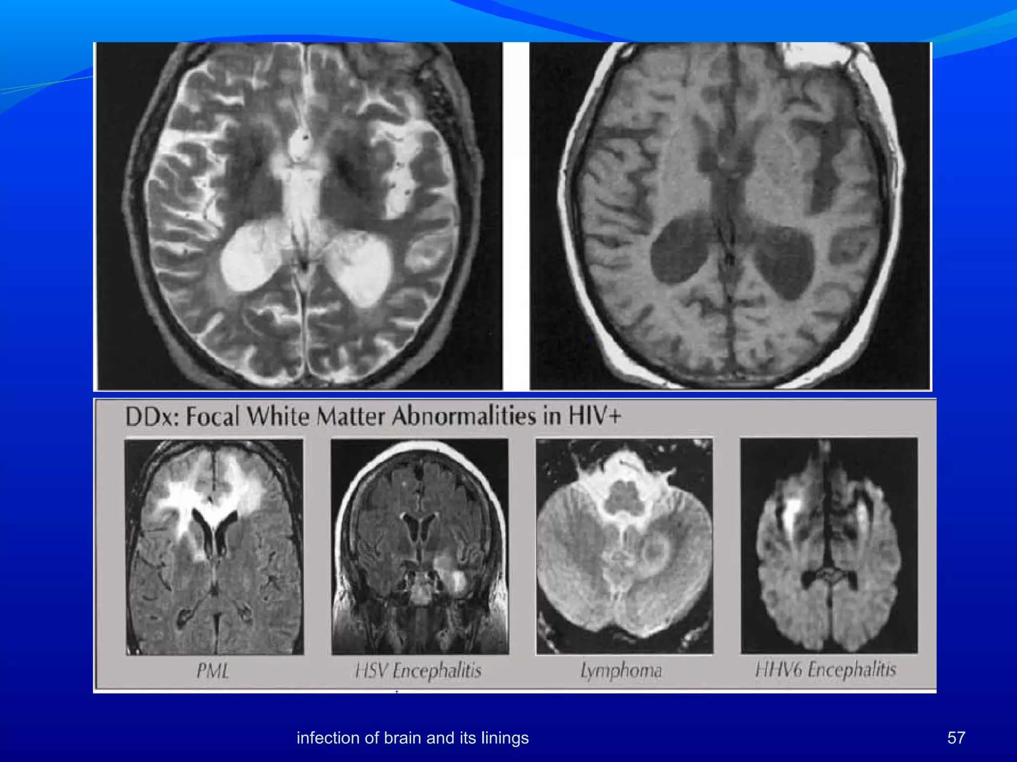 57infection of brain and its linings
 