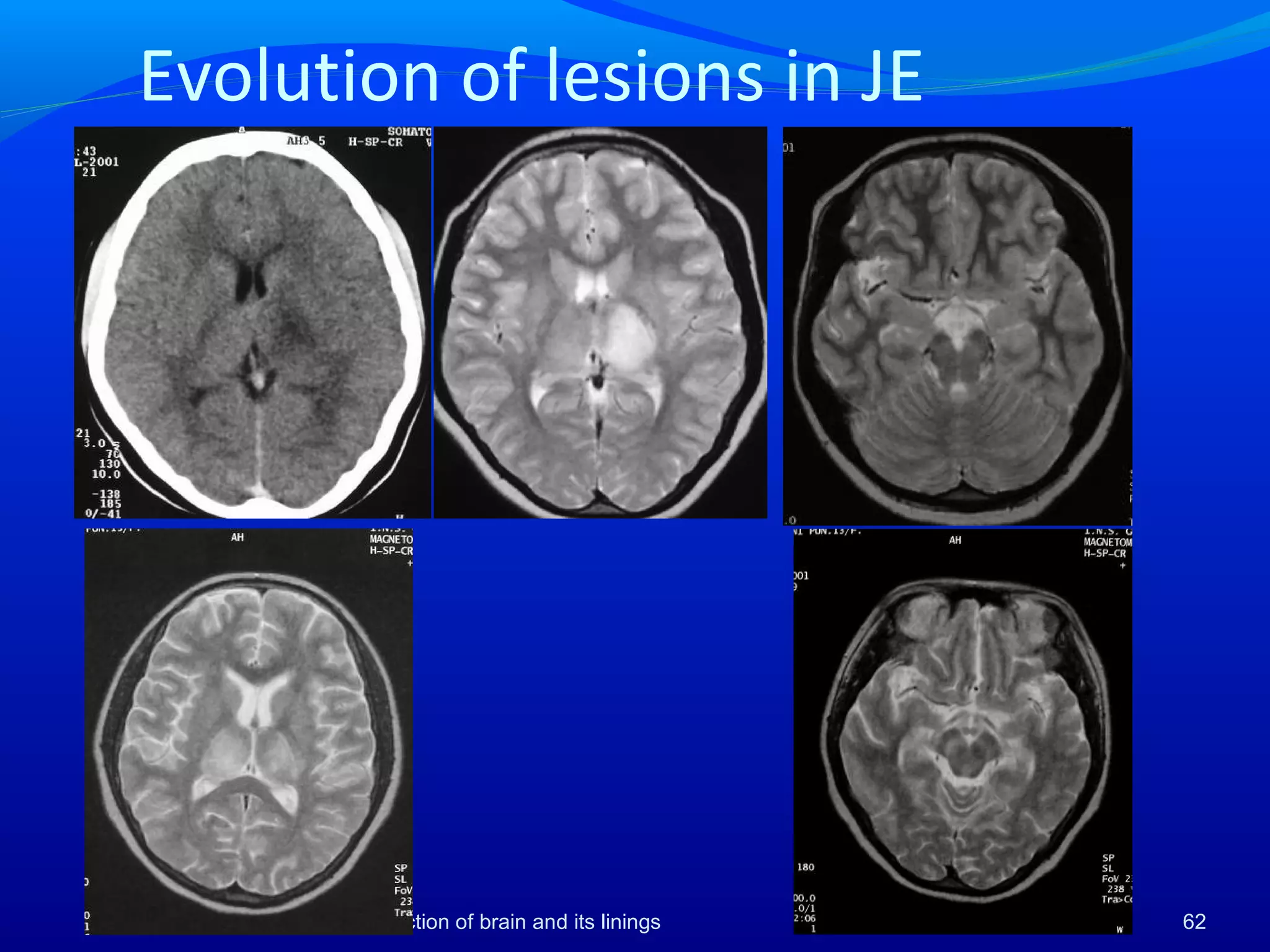 Evolution of lesions in JE
62infection of brain and its linings
 