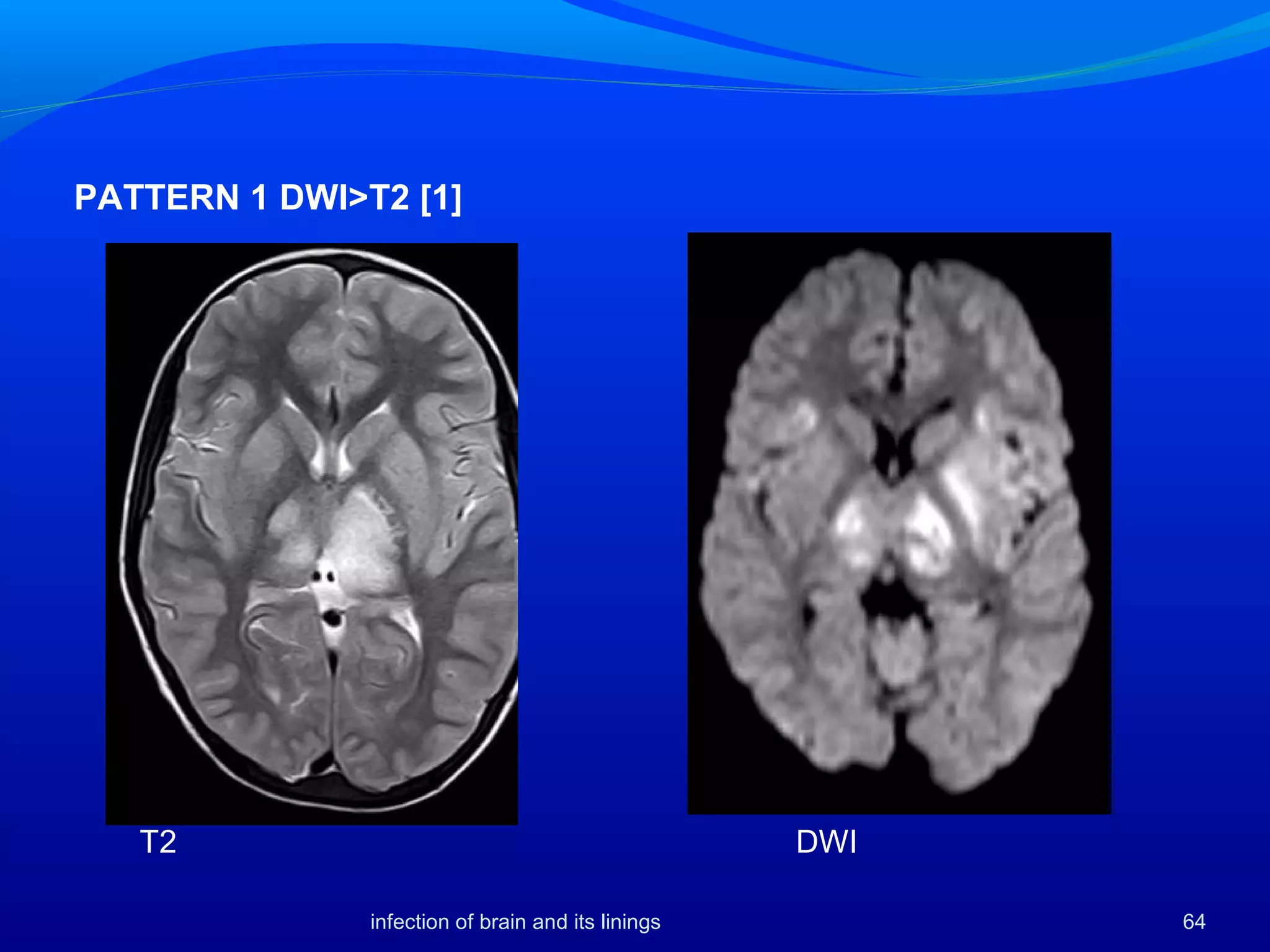 infection of brain and its linings 64
T2 DWI
PATTERN 1 DWI>T2 [1]
 