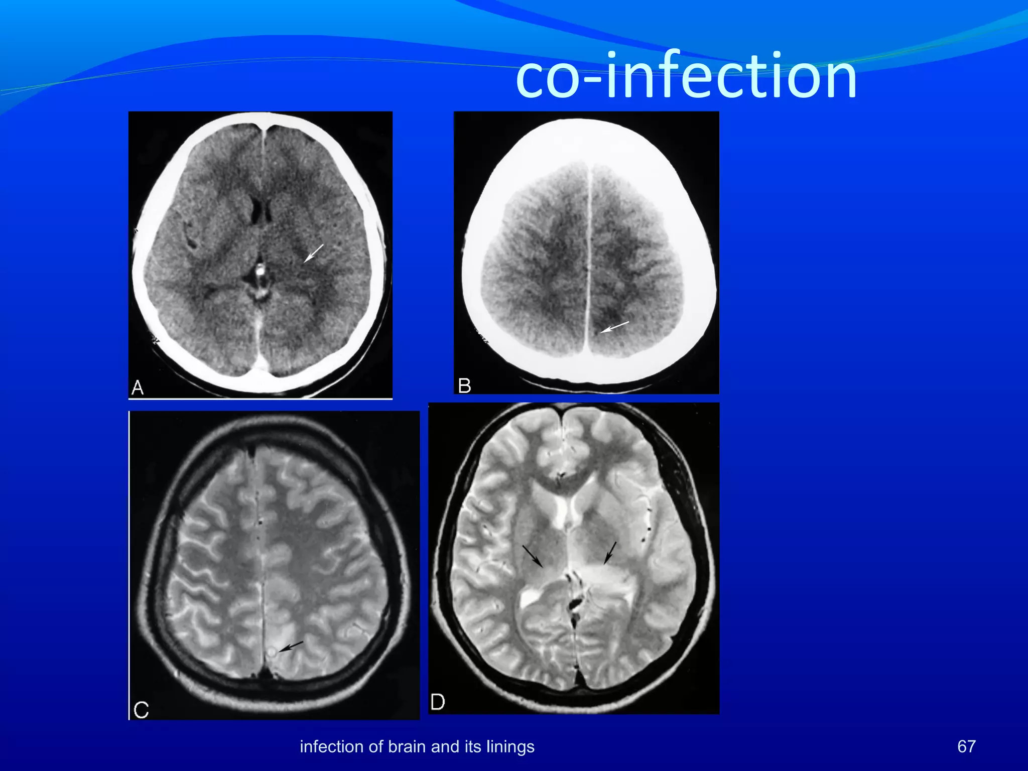 infection of brain and its linings 67
co-infection
 