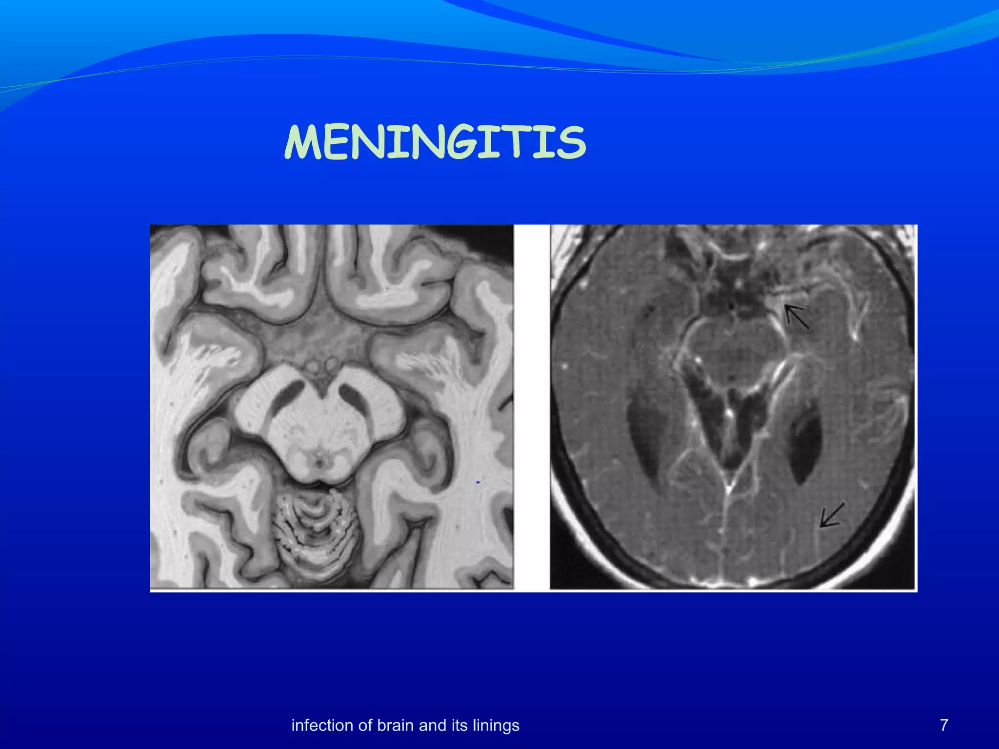 MENINGITIS
7infection of brain and its linings
 