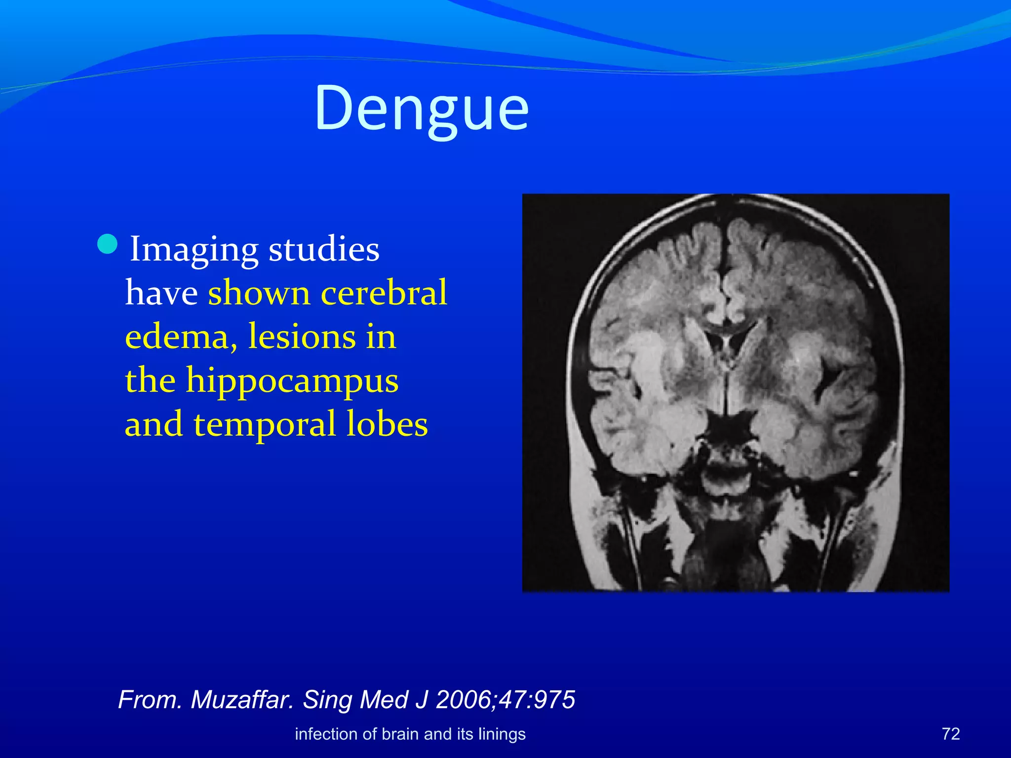 Dengue
infection of brain and its linings 72
From. Muzaffar. Sing Med J 2006;47:975
Imaging studies
have shown cerebral
edema, lesions in
the hippocampus
and temporal lobes
 