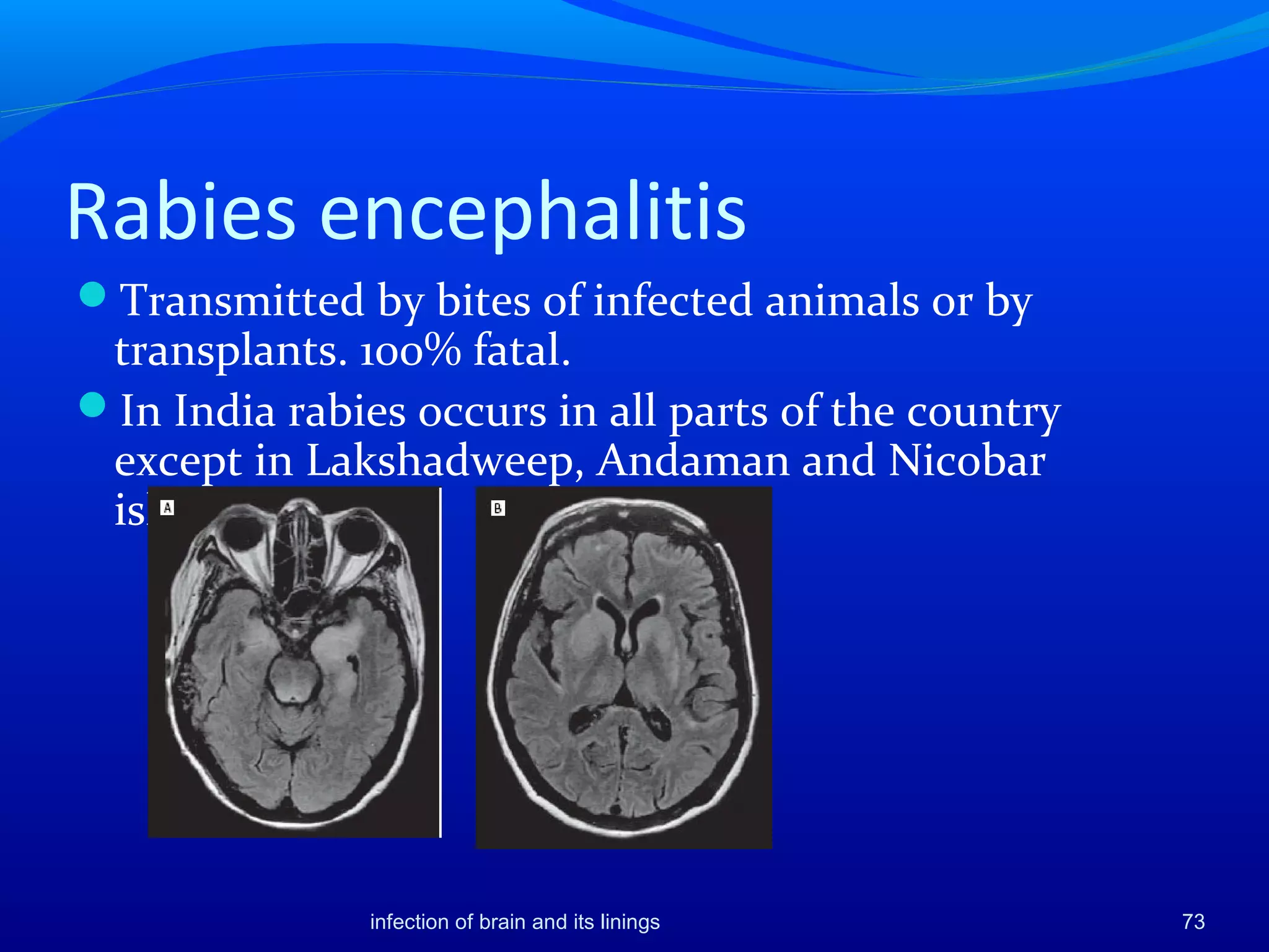 Rabies encephalitis
Transmitted by bites of infected animals or by
transplants. 100% fatal.
In India rabies occurs in all parts of the country
except in Lakshadweep, Andaman and Nicobar
islands.
73infection of brain and its linings
 
