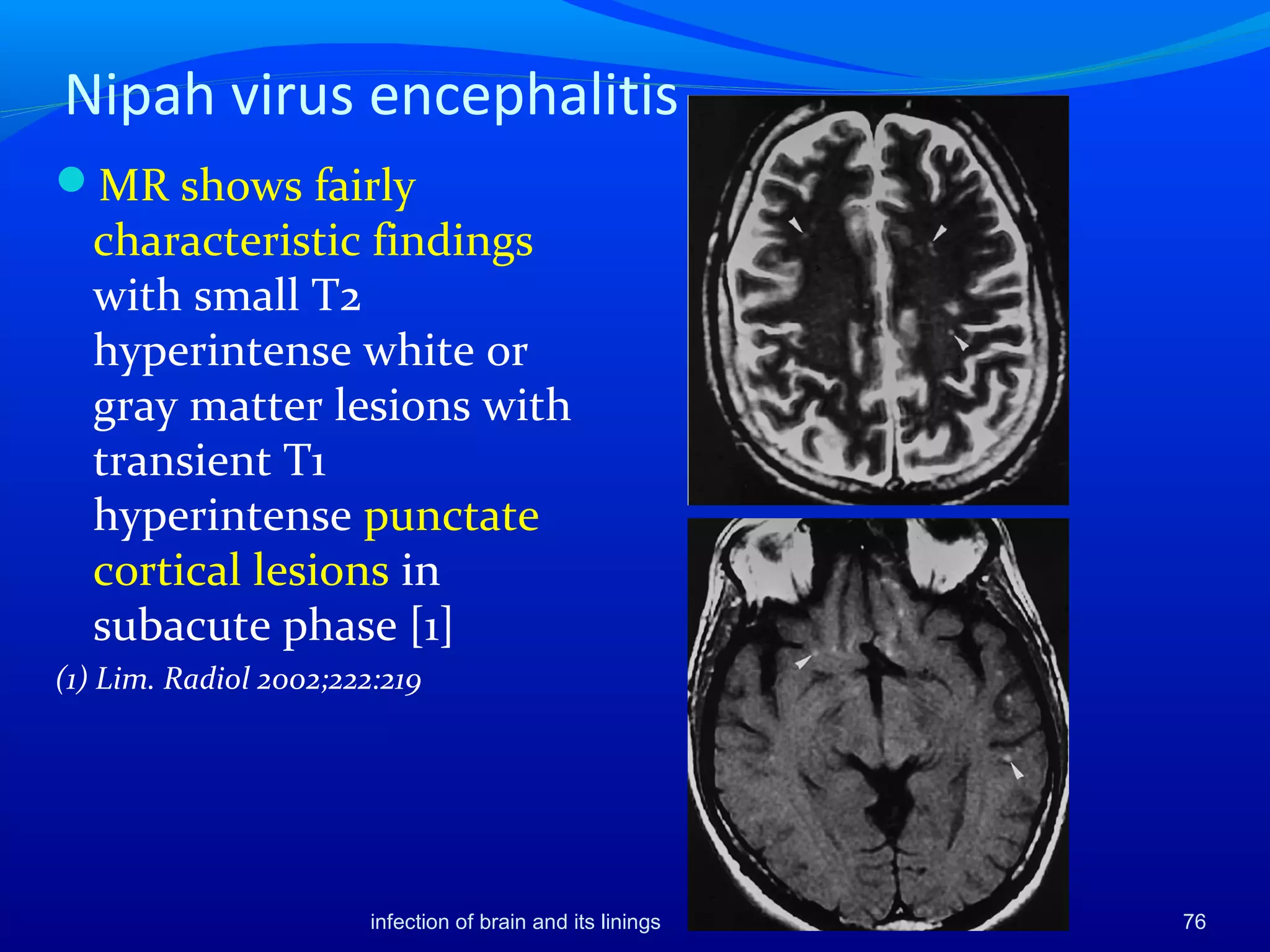 Nipah virus encephalitis
MR shows fairly
characteristic findings
with small T2
hyperintense white or
gray matter lesions with
transient T1
hyperintense punctate
cortical lesions in
subacute phase [1]
(1) Lim. Radiol 2002;222:219
infection of brain and its linings 76
 