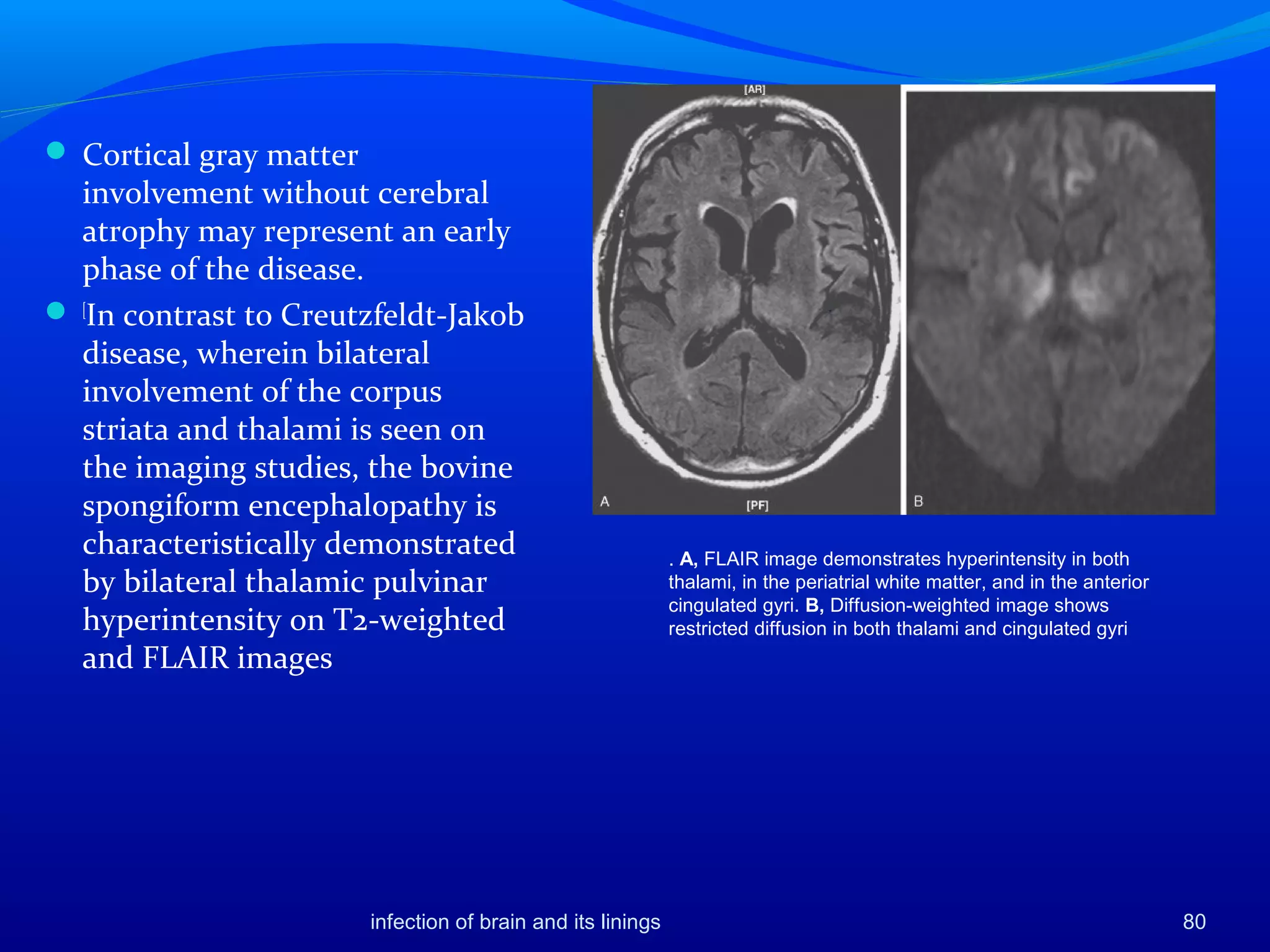 infection of brain and its linings 80
 Cortical gray matter
involvement without cerebral
atrophy may represent an early
phase of the disease.
 [
In contrast to Creutzfeldt-Jakob
disease, wherein bilateral
involvement of the corpus
striata and thalami is seen on
the imaging studies, the bovine
spongiform encephalopathy is
characteristically demonstrated
by bilateral thalamic pulvinar
hyperintensity on T2-weighted
and FLAIR images
. A, FLAIR image demonstrates hyperintensity in both
thalami, in the periatrial white matter, and in the anterior
cingulated gyri. B, Diffusion-weighted image shows
restricted diffusion in both thalami and cingulated gyri
 