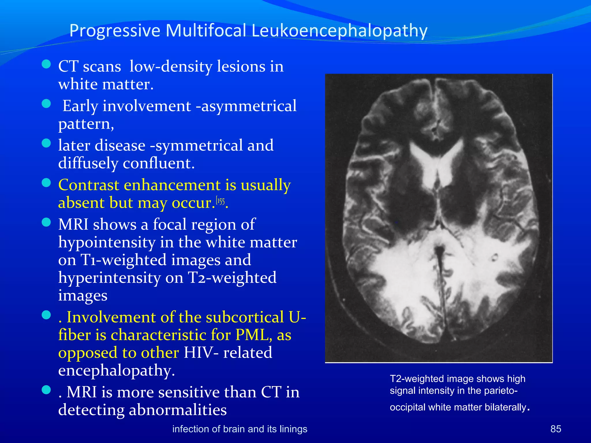 Progressive Multifocal Leukoencephalopathy
CT scans low-density lesions in
white matter.
 Early involvement -asymmetrical
pattern,
later disease -symmetrical and
diffusely confluent.
Contrast enhancement is usually
absent but may occur.[155
.
MRI shows a focal region of
hypointensity in the white matter
on T1-weighted images and
hyperintensity on T2-weighted
images
. Involvement of the subcortical U-
fiber is characteristic for PML, as
opposed to other HIV- related
encephalopathy.
. MRI is more sensitive than CT in
detecting abnormalities
T2-weighted image shows high
signal intensity in the parieto-
occipital white matter bilaterally.
85infection of brain and its linings
 