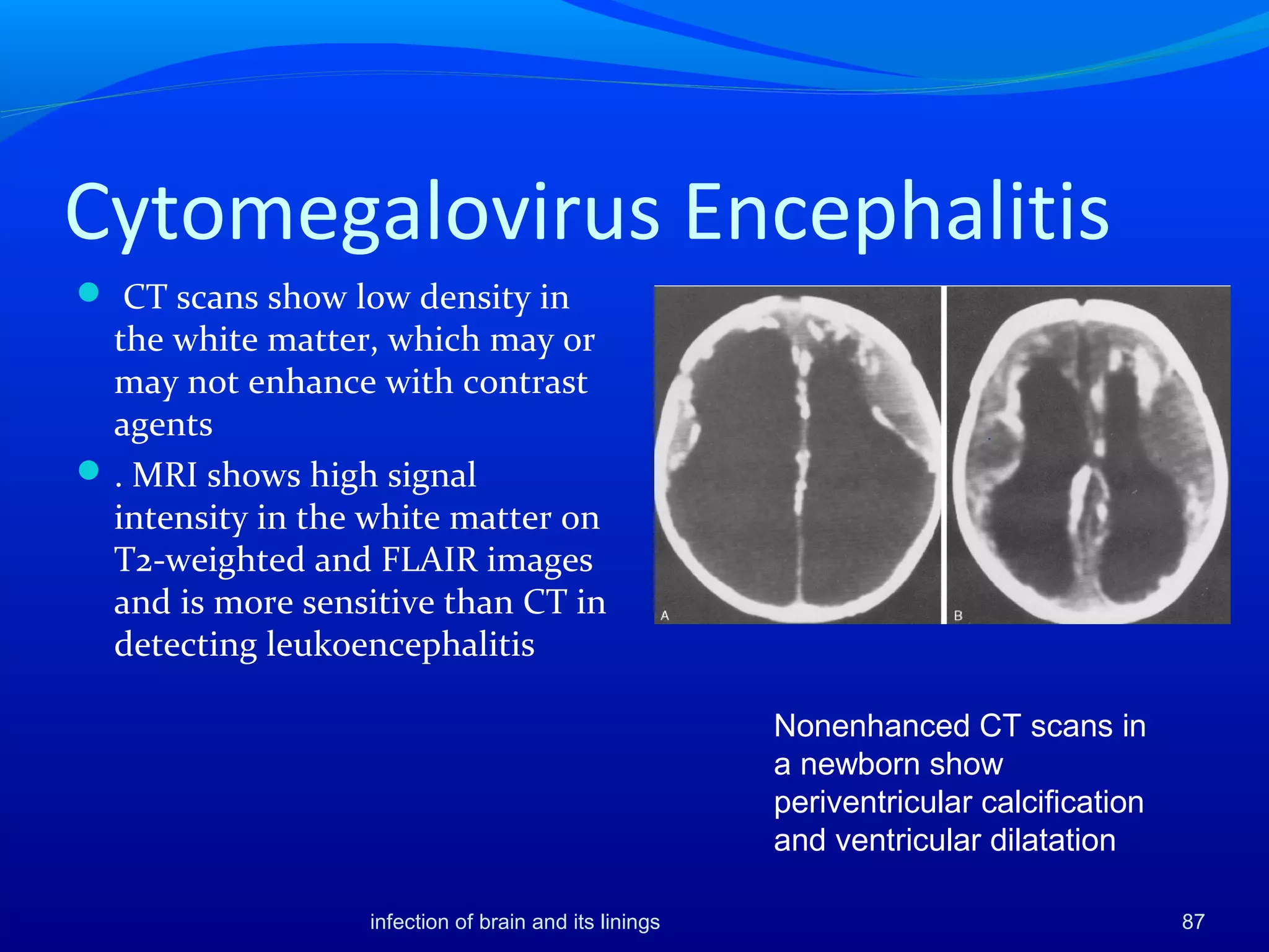  CT scans show low density in
the white matter, which may or
may not enhance with contrast
agents
. MRI shows high signal
intensity in the white matter on
T2-weighted and FLAIR images
and is more sensitive than CT in
detecting leukoencephalitis
Nonenhanced CT scans in
a newborn show
periventricular calcification
and ventricular dilatation
87infection of brain and its linings
Cytomegalovirus Encephalitis
 